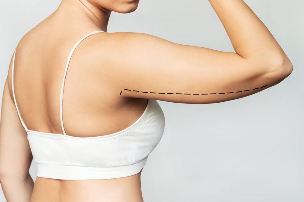 Brachioplasty