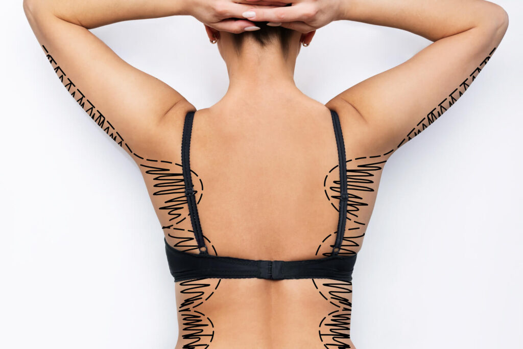 Bra Roll Excision